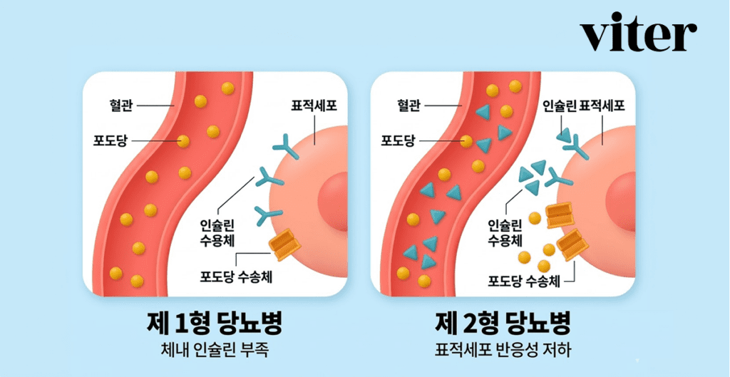 2형 당뇨병과 1형 당뇨병의 인슐린 기전 차이를 설명하는 인포그래픽
