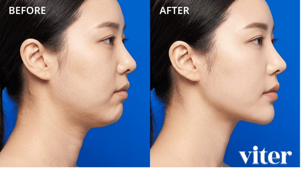 이중턱과 무턱 개선을 위한 지방분해주사 전후 측면 얼굴