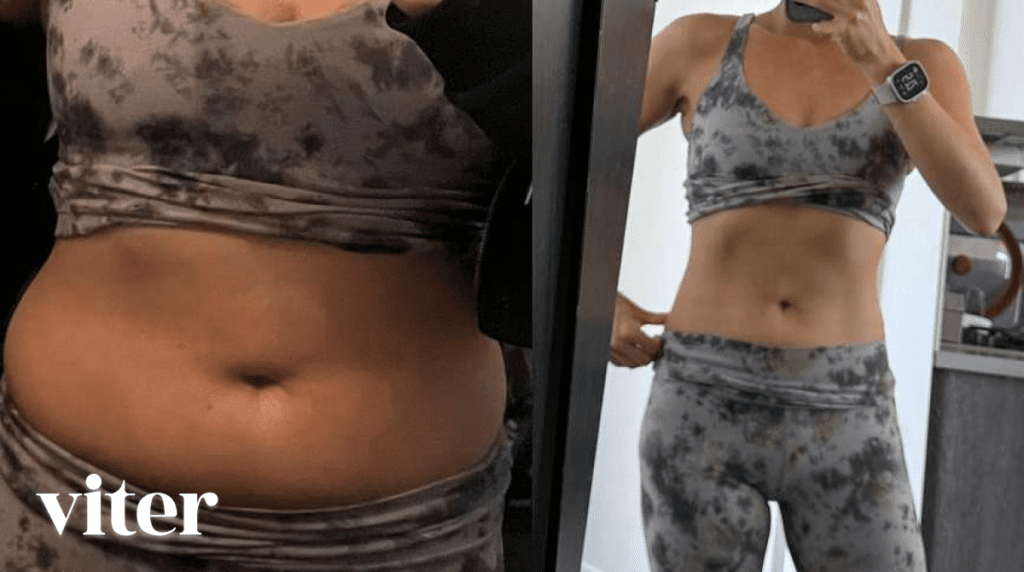 늘어진 뱃살과 복부 지방 감소를 위한 지방분해주사 후기