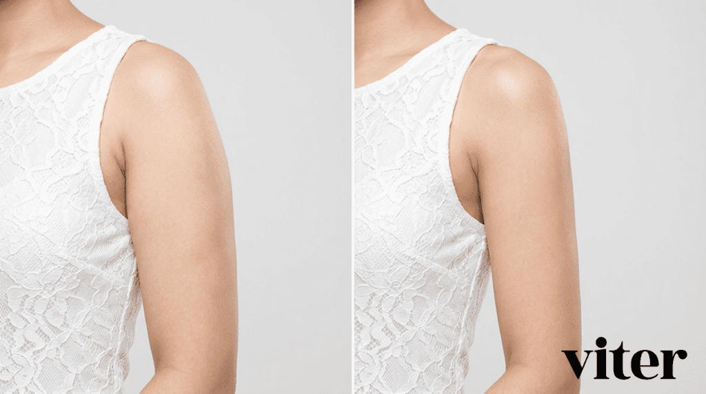 두꺼운 팔뚝살을 슬림하게 만드는 팔 지방분해주사 전후