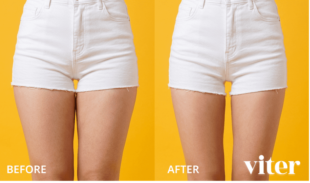 허벅지 안쪽 살을 제거하는 지방분해주사 전후 비교