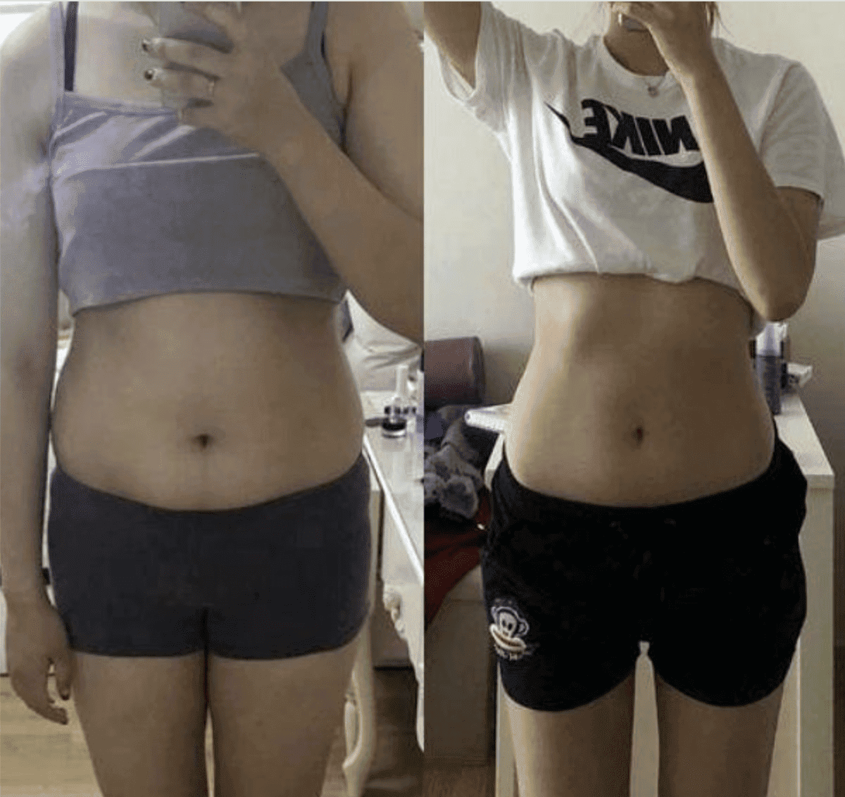 여성 복부의 피하지방 감소로 뱃살이 빠진 전후 변화.